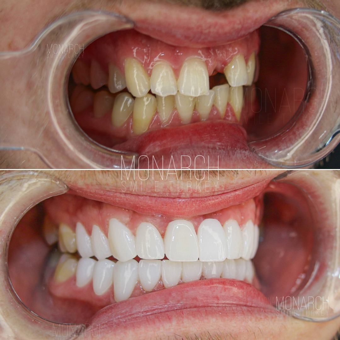 teeth-implant-turkey
