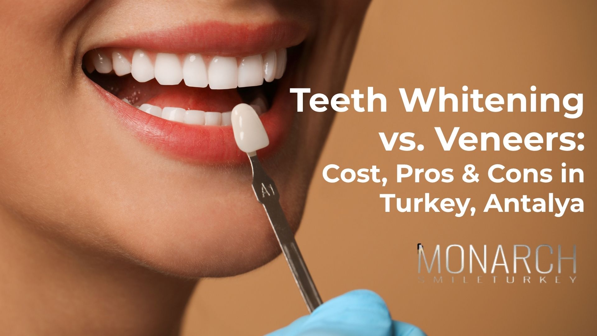  Teeth Whitening vs. Veneers