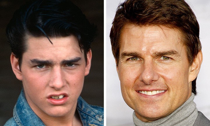 celebrities-with-veneers-tom-cruise celebrities-with-veneers-tom-cruise