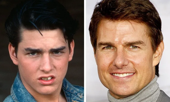 celebrities-with-veneers-tom-cruise celebrities-with-veneers-tom-cruise