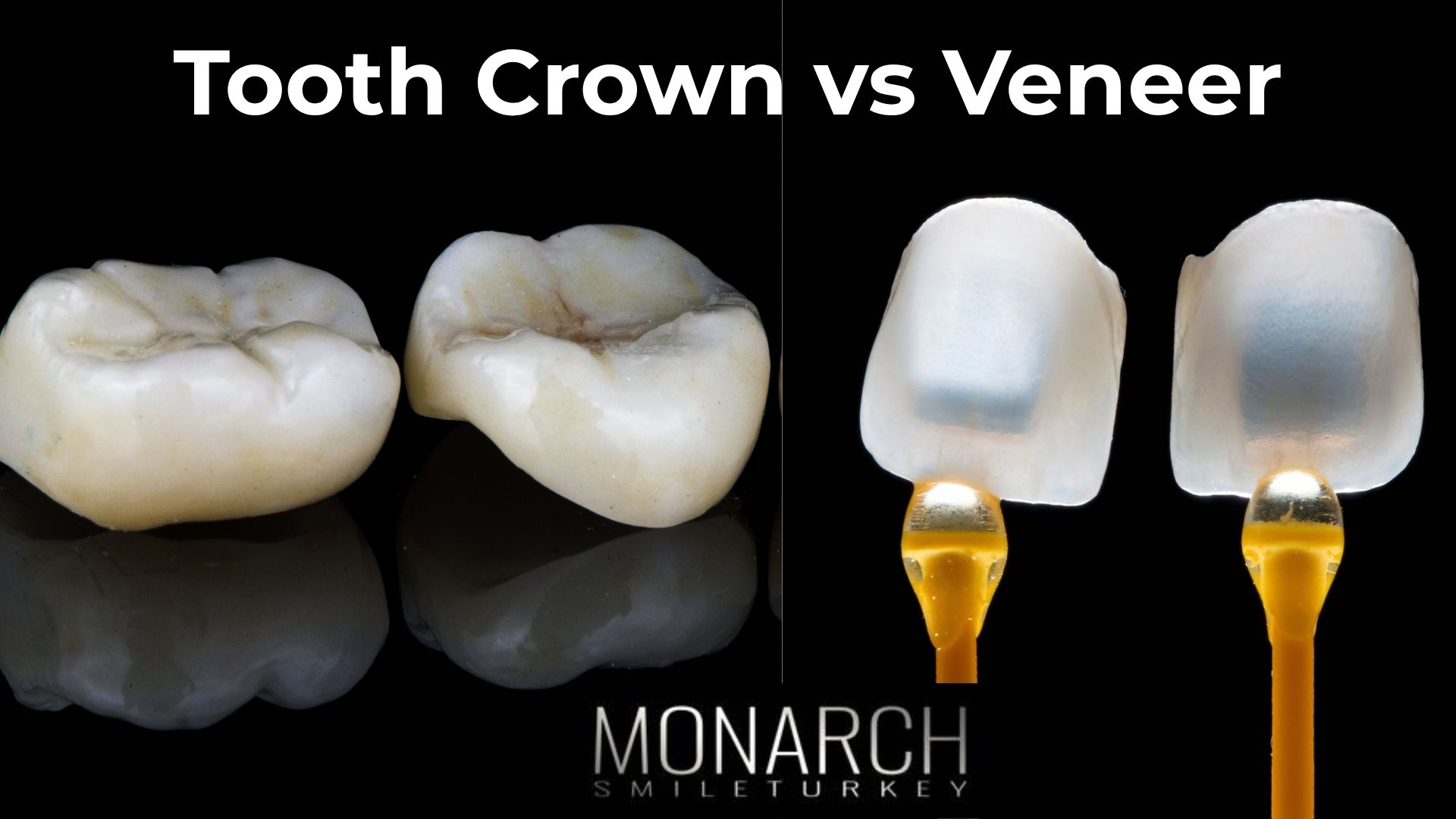 tooth-crown-vs-veneer