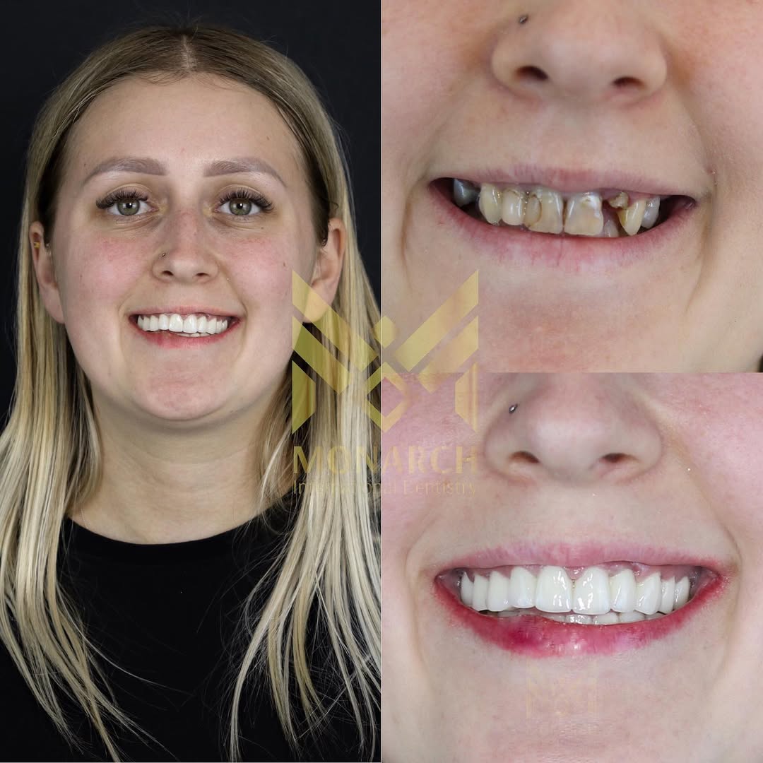 turkey-teeth-dental-clinic-antalya-before-and-after