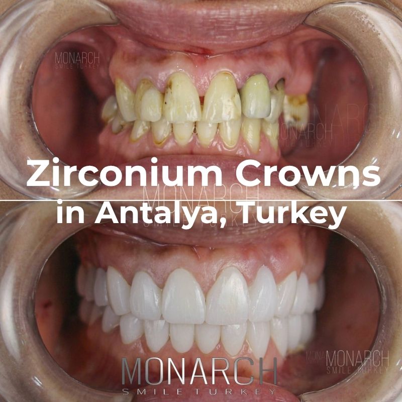 turkey-teeth-zirconium-crowns-antalya turkey-teeth-zirconium-crowns-antalya