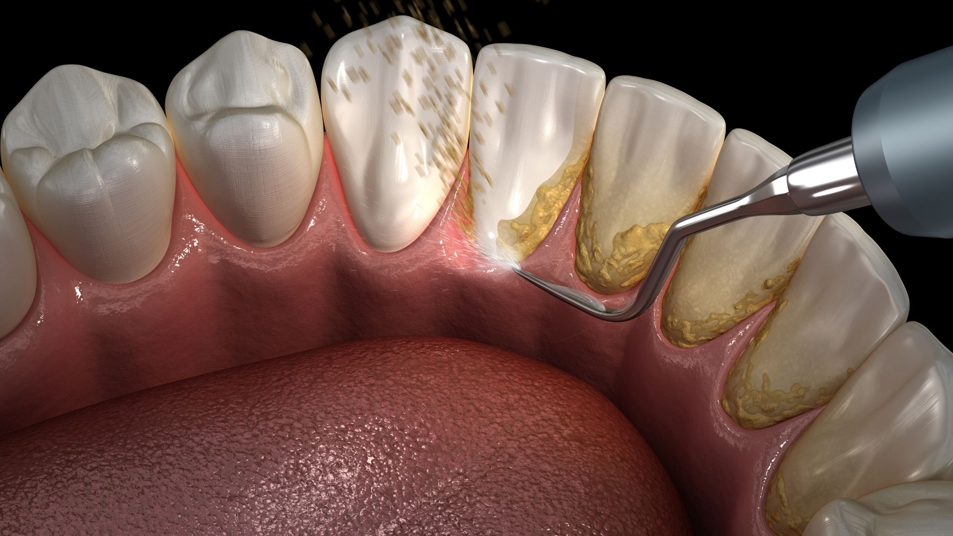  Is ultrasonic cleaning good for your teeth?