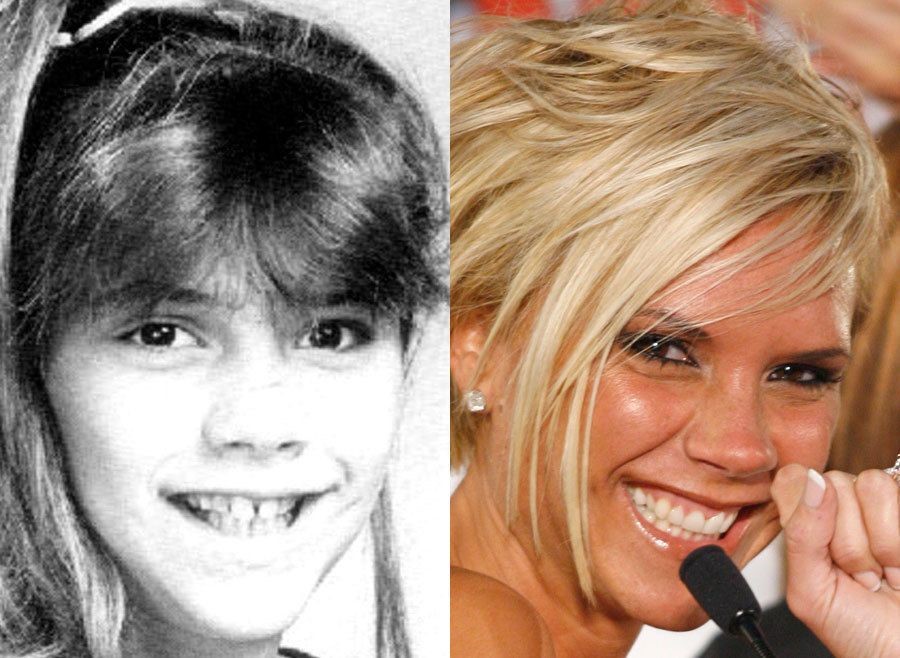 celebrities-with-veneers-Viktoria Beckham celebrities-with-veneers-Viktoria Beckham
