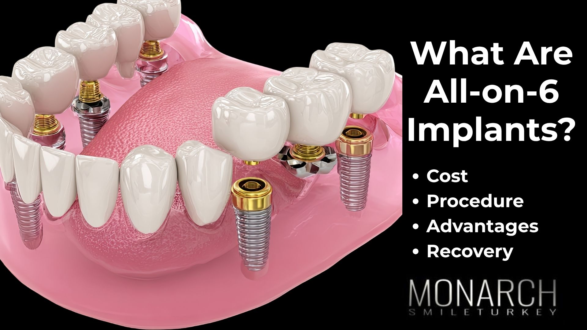 what-are-all-on-6-dental-implants-turkey-antalya? what-are-all-on-6-dental-implants-turkey-antalya?