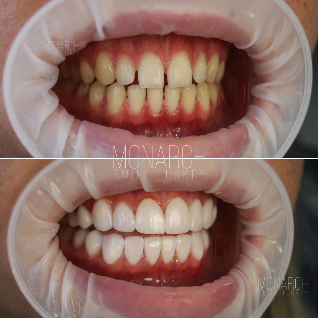 composite-bonding-before and after photos