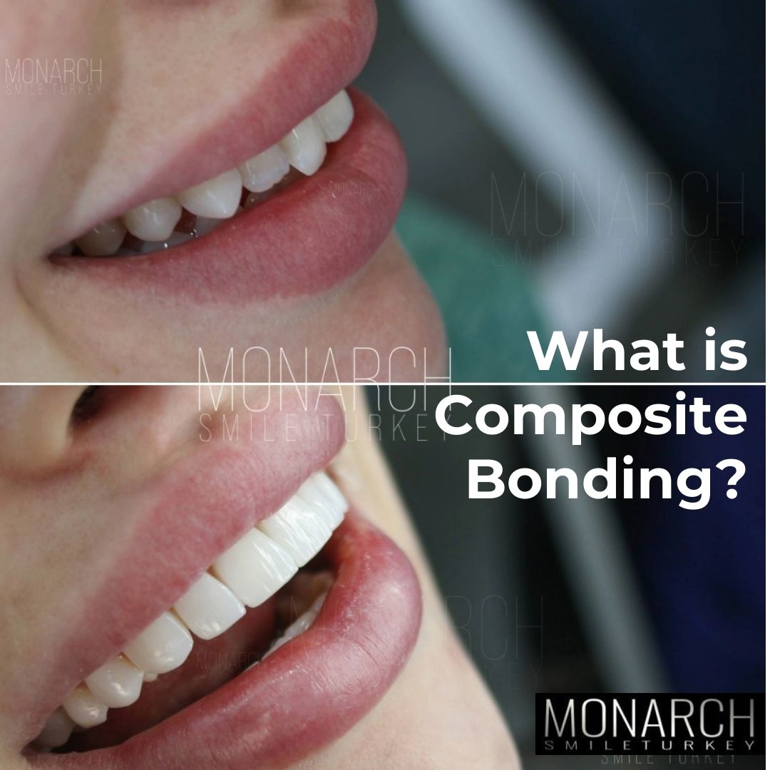 What is composite bonding?