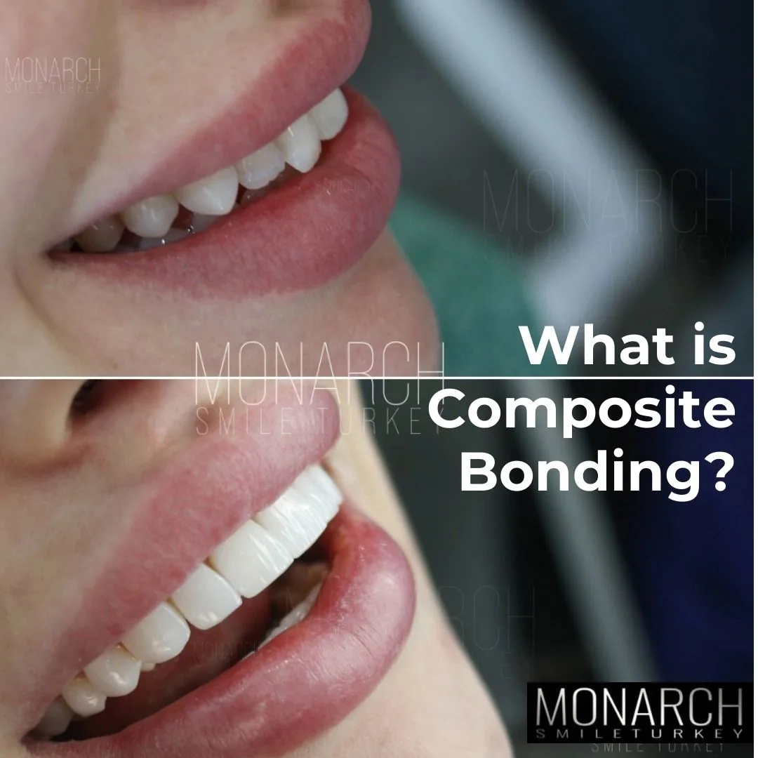 what-is-composite-bonding