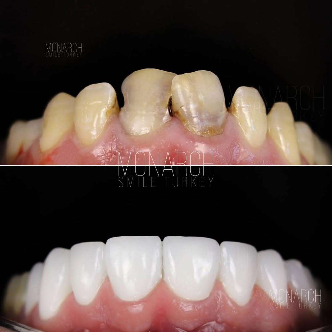 Zirconium crowns do not contain metal and are biocompatible in turkey antalya