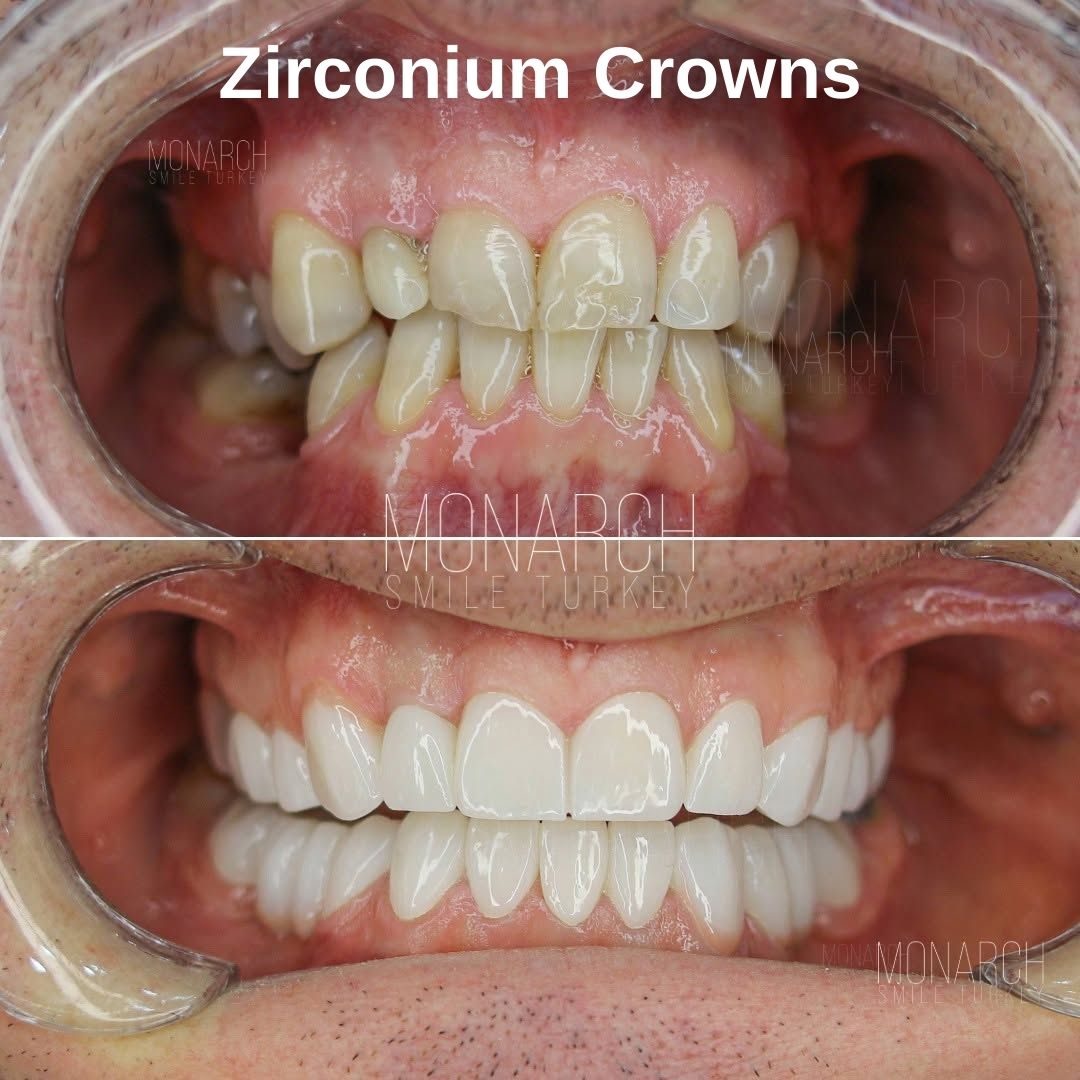 when-to-use-zirconia-turkey-antalya