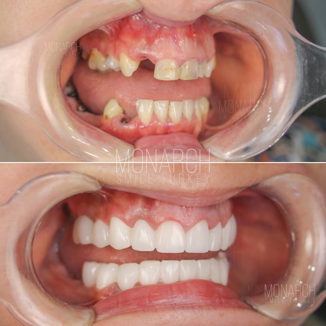 Improved appearance of dental implant