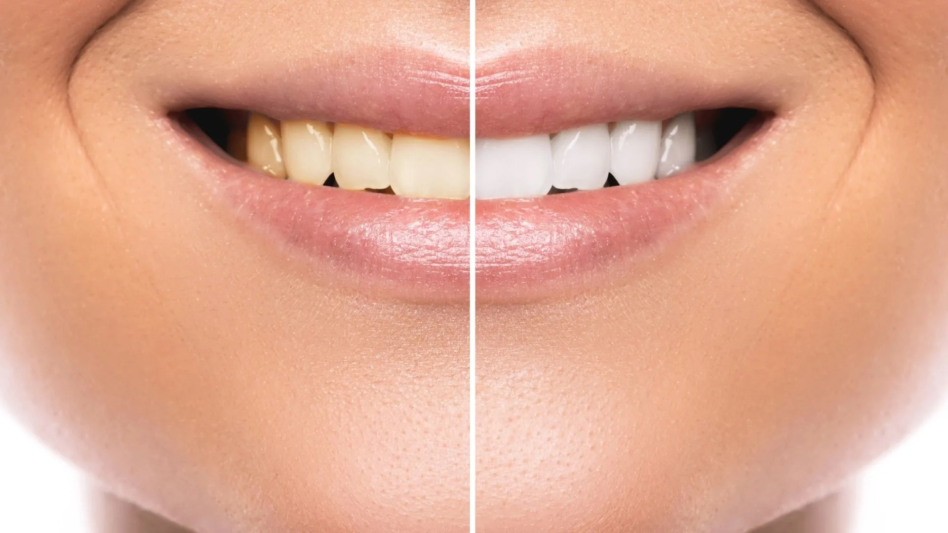 teeth whitening yellow-teeth and teeth whitening