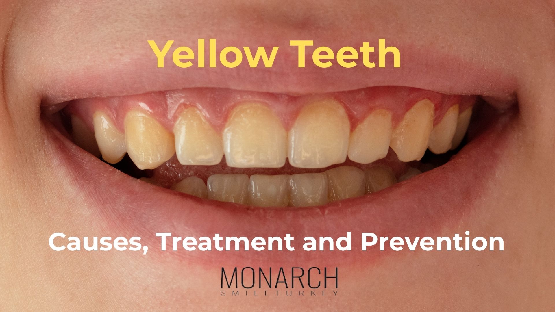 yellow-teeth