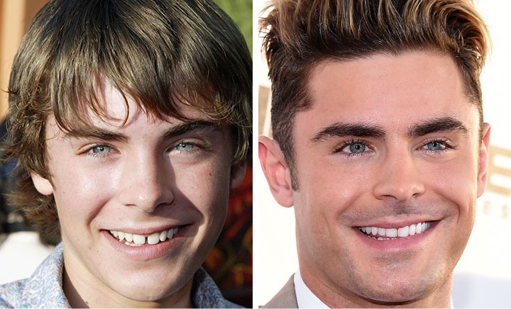 celebrities-with-veneers-zac-efron celebrities-with-veneers-zac-efron