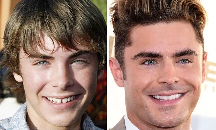 celebrities-with-veneers-zac-efron celebrities-with-veneers-zac-efron