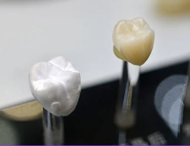 Things You should Know About Zirconia Dental Crowns