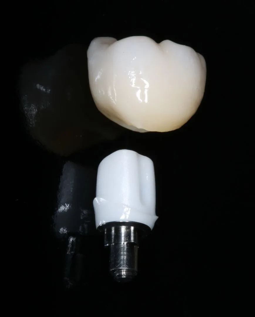 is-it-worth-getting-zirconium-crowns-in-turkey
