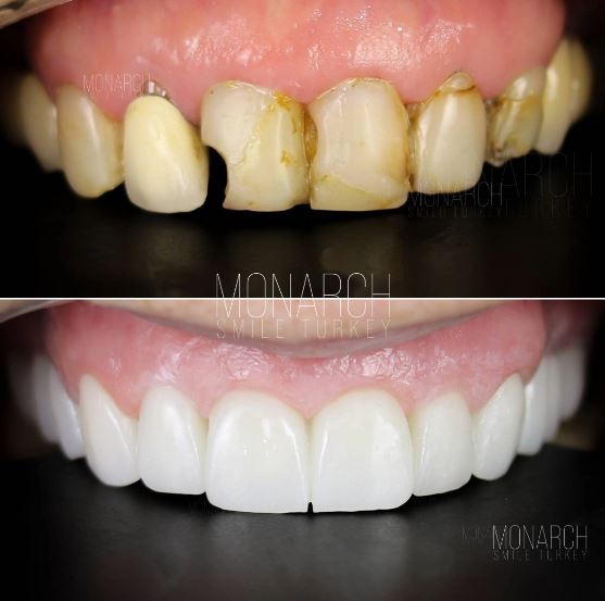 Zirconium crown and veneer Turkey cost