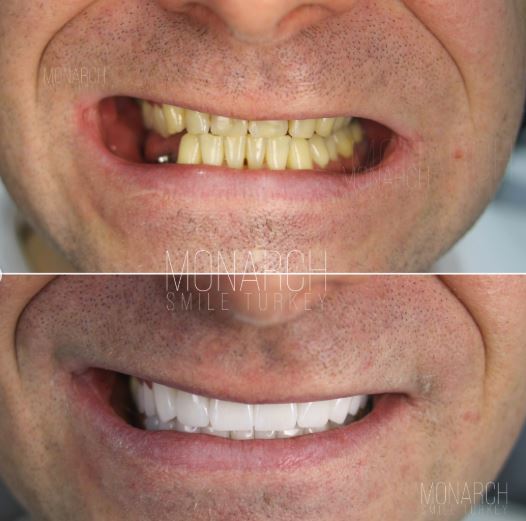 How zirconium crowns differ from traditional crowns? in turkey, antalya