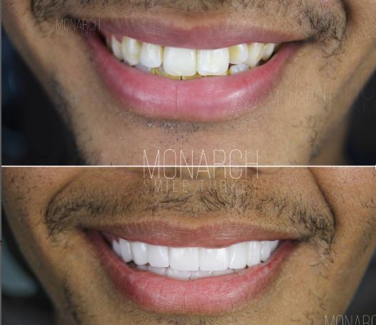 zirconium-crown-smile-makeover in turkey, antalya