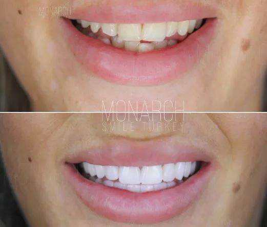are-zirconium-crowns-worth-it-turkey-antalya