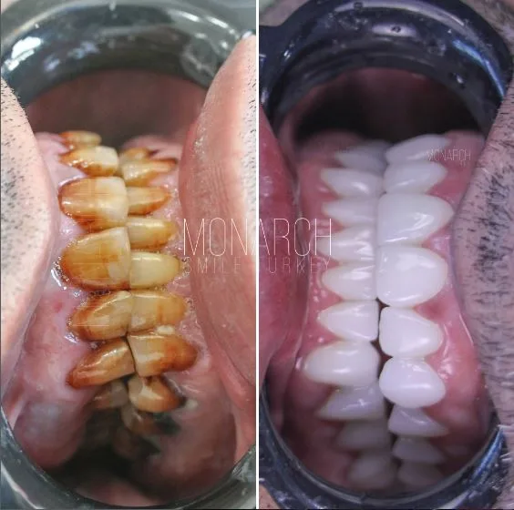 zirconium-crowns-full-set in turkey Antalya