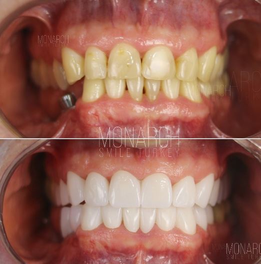 zirconium-crowns-before-and-after-photos-turkey