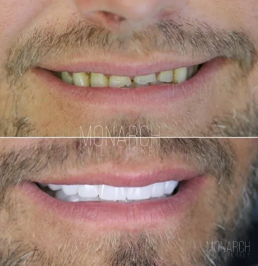 zirconium-crowns-photos-10