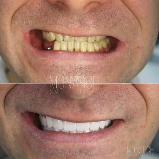 zirconium-crowns-photos-2