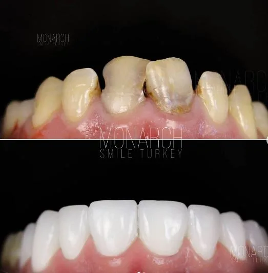 Zirconia crowns
