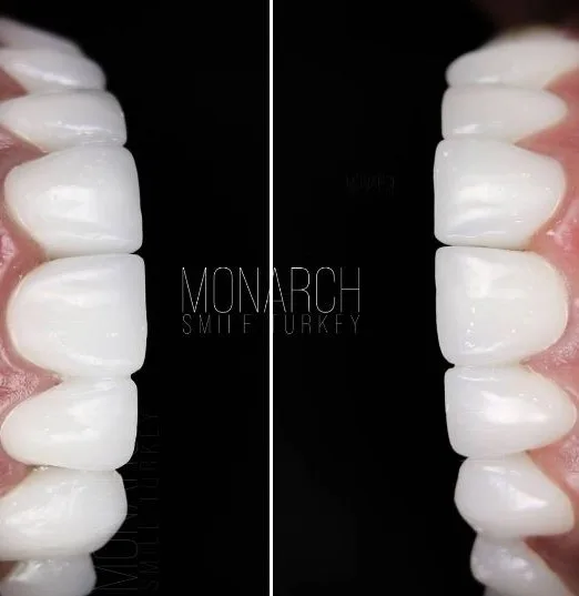 zirconium-crowns-photos-4