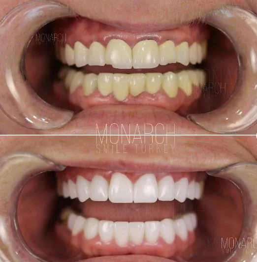 zirconium-crowns-photos-5