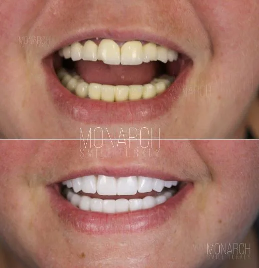zirconium-crowns-photos-6