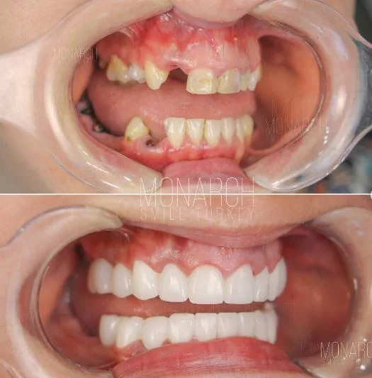 zirconium-crowns-photos-7