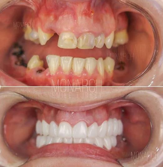 zirconium-crowns-photos-8
