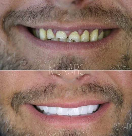 zirconium-crowns-photos-9